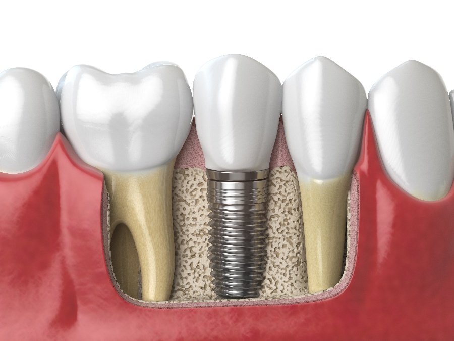 How Long Do Dental Implants Last?